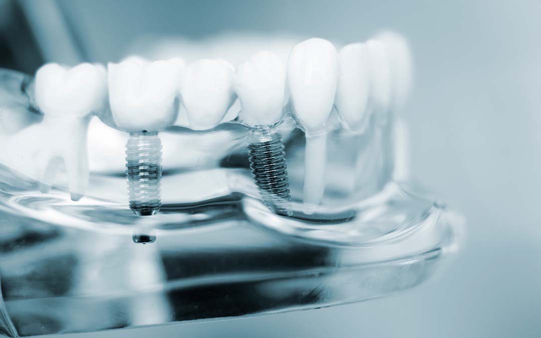 Ocala Florida Dental Implant Dentist